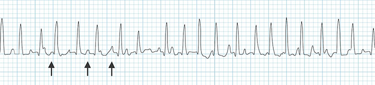 ECG Multifocal (Multiform) atrial tachycardia (MAT), irregular narrow complex QRS tachycardia