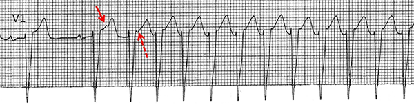 ECG Paroxysmal supraventricular tachycardia, Typical AVNRT (Slow-Fast), Atrial premature complex, Pseudo-R-wave (V1)