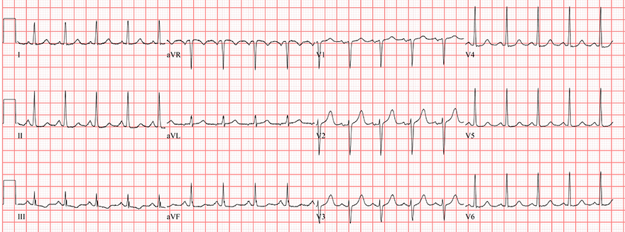 ECG Sino-atrial nodal reentrant tachycardia (SANRT)