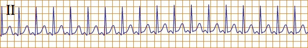 ECG Sinoatrial nodal reentrant (reentry) tachycardia (SANRT)