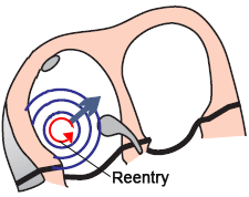 atrial reentry, Intra-atrial reentry/reentrant tachycardia (IART)