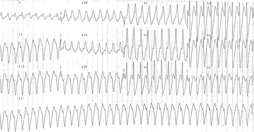 ECG monomorphic ventricular tachycardia RBBB pattern, superior axis, Transition zone V3