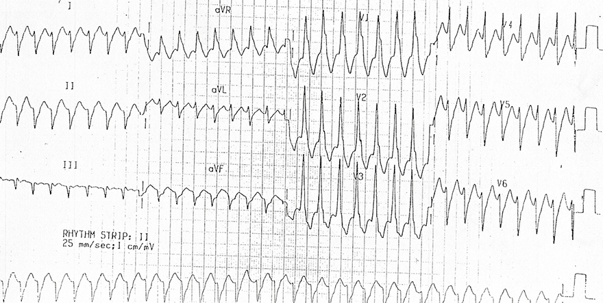 ECG ventricular tachycardia RBBB pattern, superior axis, Transition zone V4